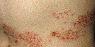 Những nguy cơ mắc bệnh khi tắm ở bể bơi quá tải