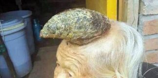 Kinh hãi cụ bà 87 tuổi mọc sừng “khủng” trên đầu