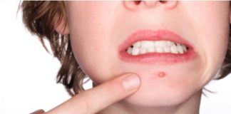 Cách trị mụn bằng mặt nạ bột nghệ - 1