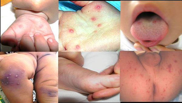 Làm sao để phân biệt bệnh tay chân miệng với sốt virus nổi ban