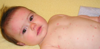 Các cách xử lý và phòng tránh bệnh thủy đậu