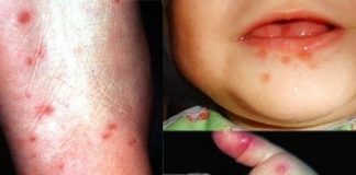 Những bệnh nguy hiểm, dễ lây nhất