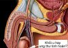 Cẩn thận ung thư tinh hoàn nếu không muốn "mất giống"