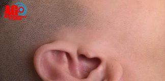 Xỏ nhiều lỗ tai, thanh niên 17 tuổi bị khối u to, biến dạng tai