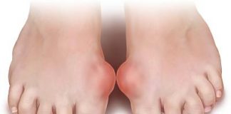 Bị bệnh gút nên ăn gì? - 1