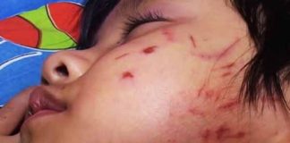 Giáo viên bỏ lớp, bé gái 4 tuổi bị bạn vây đánh, cào rách mặt