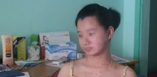 Cuộc sống tăm tối của 2 cô gái bị tạt axít ở Sài Gòn