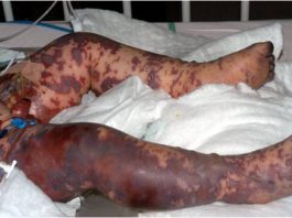 Triệu chứng cho thấy bạn đã mắc bệnh viêm não mô cầu 1