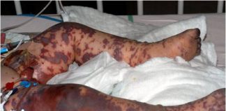 Triệu chứng cho thấy bạn đã mắc bệnh viêm não mô cầu 1