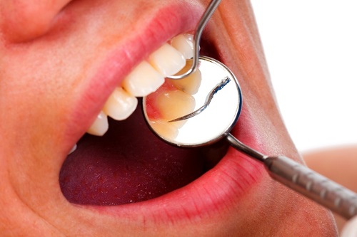 12 kiến thức cơ bản về răng bạn cần biết 8