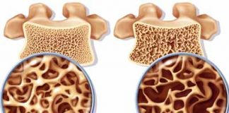 6 điều cần biết về bệnh loãng xương