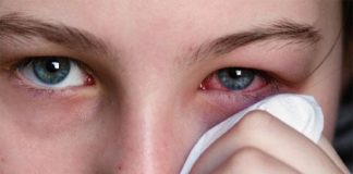 Mẹo chữa đau mắt đỏ hữu hiệu bằng khoai tây và mật ong