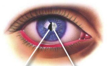 Những bệnh ở mắt có thể dẫn đến mù lòa 1