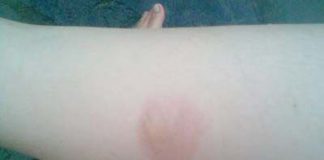 Chữa bỏng hiệu quả theo kinh nghiệm dân gian