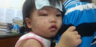 Bé một tuổi bị cào cấu chi chít tại nhà trẻ tư
