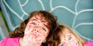 Cảnh báo tình trạng bệnh sởi lây lan nghiêm trọng