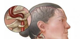 Đột quỵ - bệnh nguy hiểm dễ chết người mắc vào mùa đông