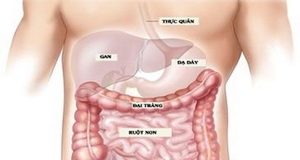 Bệnh viêm đại tràng kích thích