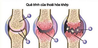 Bí quyết ăn uống phòng ngừa thoái hóa khớp