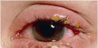 Bệnh đau mắt đỏ: nguyên nhân, phòng và trị bệnh đau mắt hiệu quả