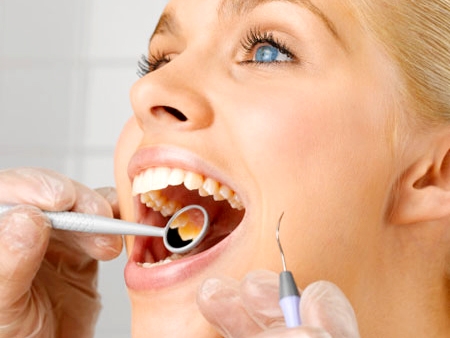 Bí quyết phòng ngừa cao răng - 2