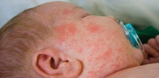 Giải đáp các câu hỏi xung quanh về "bệnh sởi"