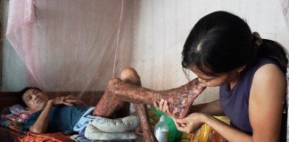 Người đàn ông bị bỏng nặng do bất ngờ ngất xỉu khi đang đốt vỏ ngô