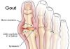 Yếu tố làm tăng nguy cơ bệnh gút