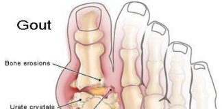 Yếu tố làm tăng nguy cơ bệnh gút