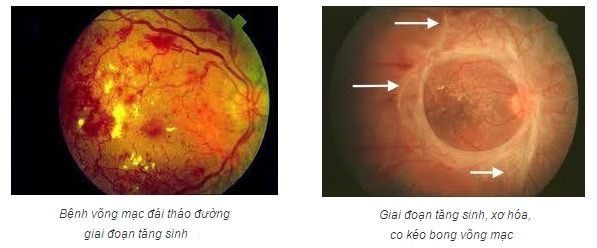 Những bệnh ở mắt có thể dẫn đến mù lòa 2