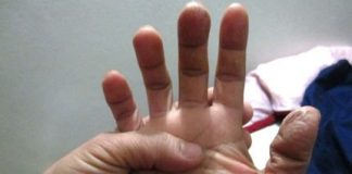 Điều trị bệnh cước chân tay bằng những bài thuốc đơn giản