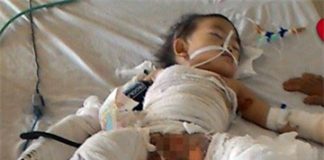 Nỗi đau thấu da thấu thịt của bé 2 tuổi bị nồi canh đang sôi đổ lên người