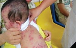 Bài thuốc đông y trị sởi cực hiệu quả