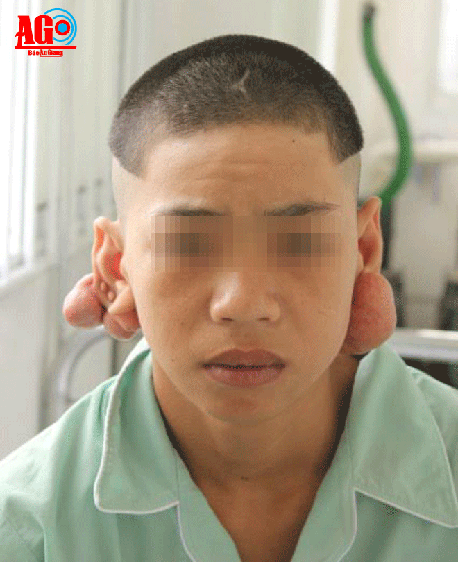 Xỏ nhiều lỗ tai, thanh niên 17 tuổi bị khối u to, biến dạng tai