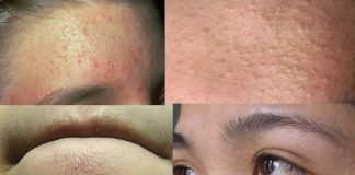 Cách trị mụn ẩn hiệu quả từ mặt nạ mướp đắng