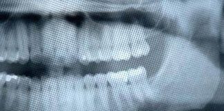 Nguy cơ u não khi chụp x-quang răng