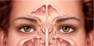 Sai lầm tự chữa viêm mũi, viêm xoang dễ gây mù mắt