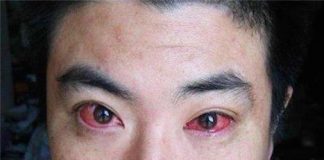 Người đàn ông bị chẩn đoán ung thư mắt vì làm điều này trong đêm