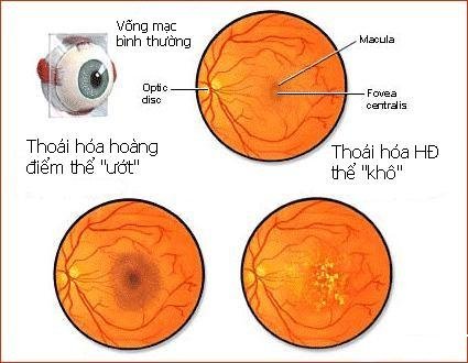 Những bệnh ở mắt có thể dẫn đến mù lòa 4