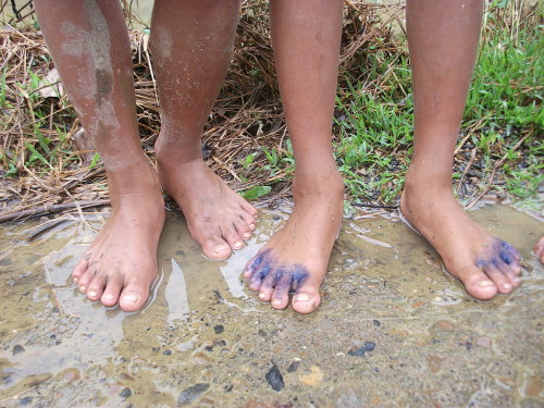 Các bệnh về da trong mùa mưa lũ và cách điều trị