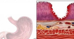 Những dấu hiệu loét đường tiêu hóa