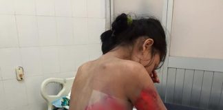 Xót xa người phụ nữ nghèo bị phồng rộp toàn thân vì bọ cạp cắn