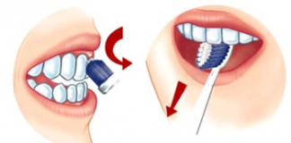 Điều trị mòn răng có khó không?