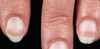 Cách chuẩn đoán bệnh qua móng tay