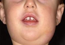 Viêm tuyến nước bọt, bệnh lý gần giống với quai bị-1