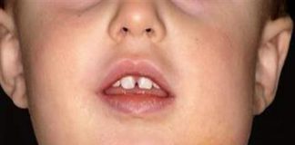 Viêm tuyến nước bọt, bệnh lý gần giống với quai bị-1