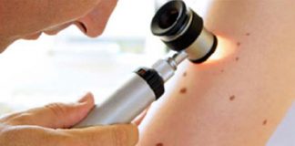 Cảnh báo bệnh ung thư da qua nốt ruồi - 1