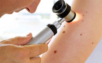 Cảnh báo bệnh ung thư da qua nốt ruồi - 1