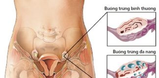 Buồng trứng đa nang, điều trị sao cho "chuẩn"?