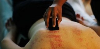 Hướng dẫn cách cạo gió an toàn và đúng kỹ thuật 1